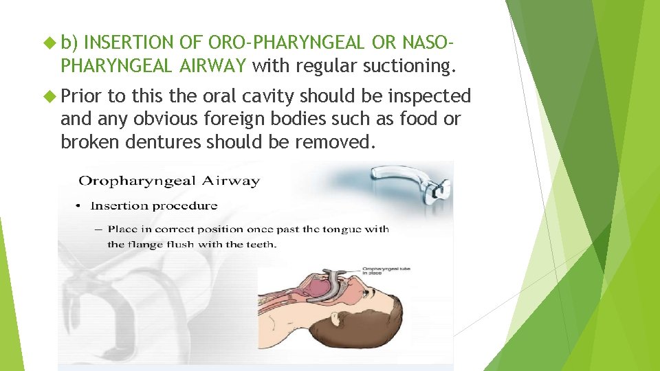  b) INSERTION OF ORO-PHARYNGEAL OR NASOPHARYNGEAL AIRWAY with regular suctioning. Prior to this