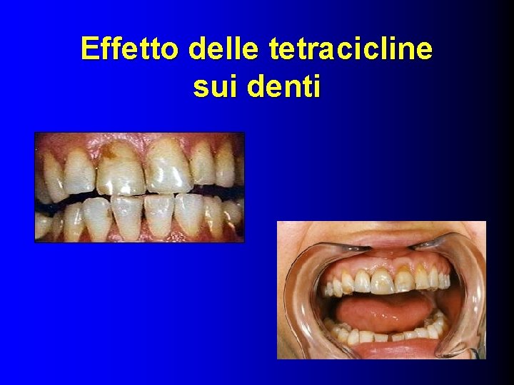 Effetto delle tetracicline sui denti 