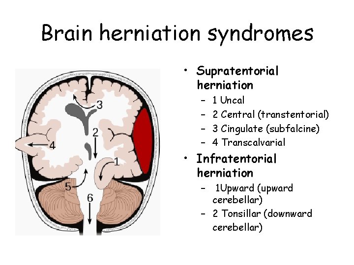 Brain herniation syndromes • Supratentorial herniation – – 1 Uncal 2 Central (transtentorial) 3