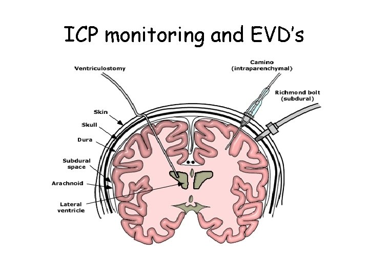 ICP monitoring and EVD’s 