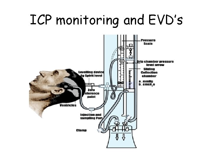 ICP monitoring and EVD’s 