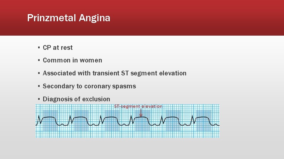 Prinzmetal Angina ▪ CP at rest ▪ Common in women ▪ Associated with transient