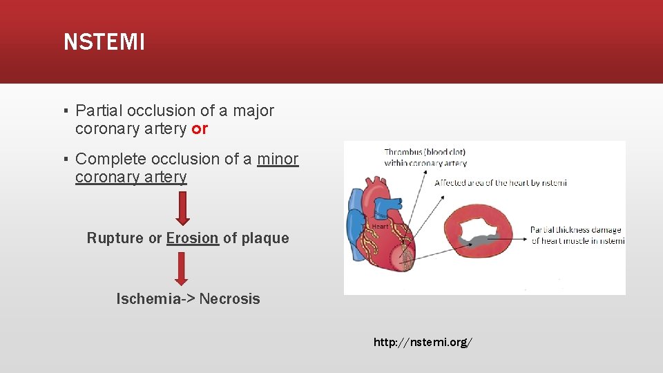 NSTEMI ▪ Partial occlusion of a major coronary artery or ▪ Complete occlusion of