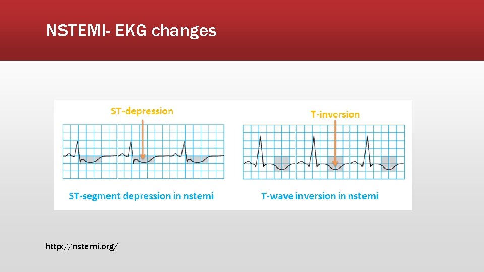 NSTEMI- EKG changes http: //nstemi. org/ 