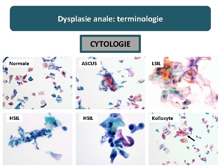 Dysplasie anale: terminologie CYTOLOGIE Normale ASCUS LSIL HSIL Koïlocyte 