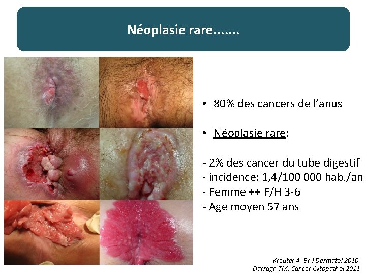 Néoplasie rare. . . . • 80% des cancers de l’anus • Néoplasie rare: