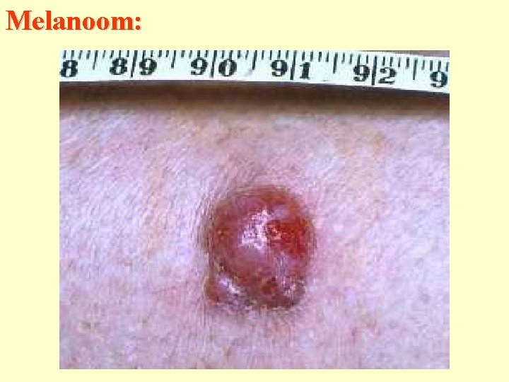 Melanoom: 