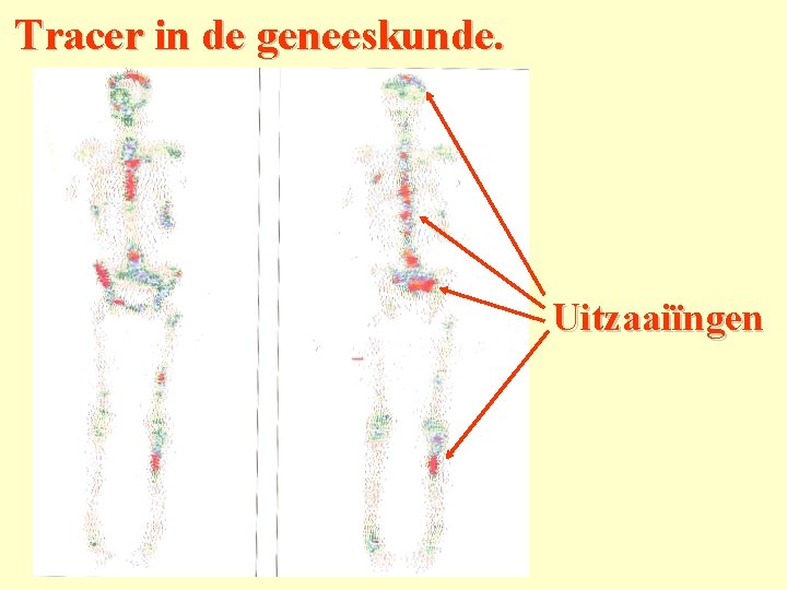Tracer in de geneeskunde. Uitzaaiïngen 