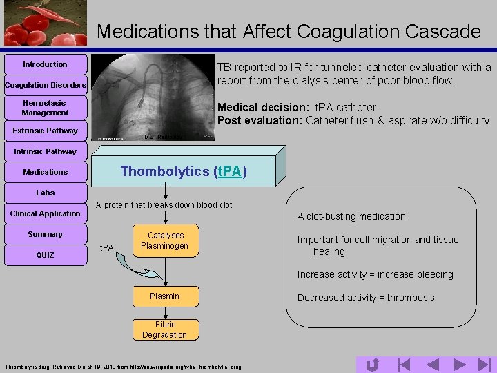 Medications that Affect Coagulation Cascade Introduction TB reported to IR for tunneled catheter evaluation