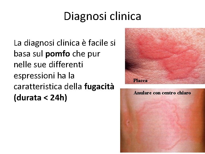 Diagnosi clinica La diagnosi clinica è facile si basa sul pomfo che pur nelle