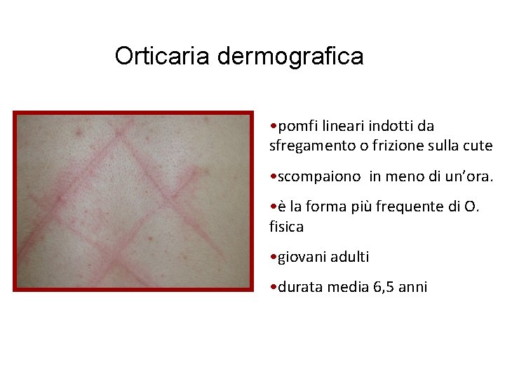 Orticaria dermografica • pomfi lineari indotti da sfregamento o frizione sulla cute • scompaiono