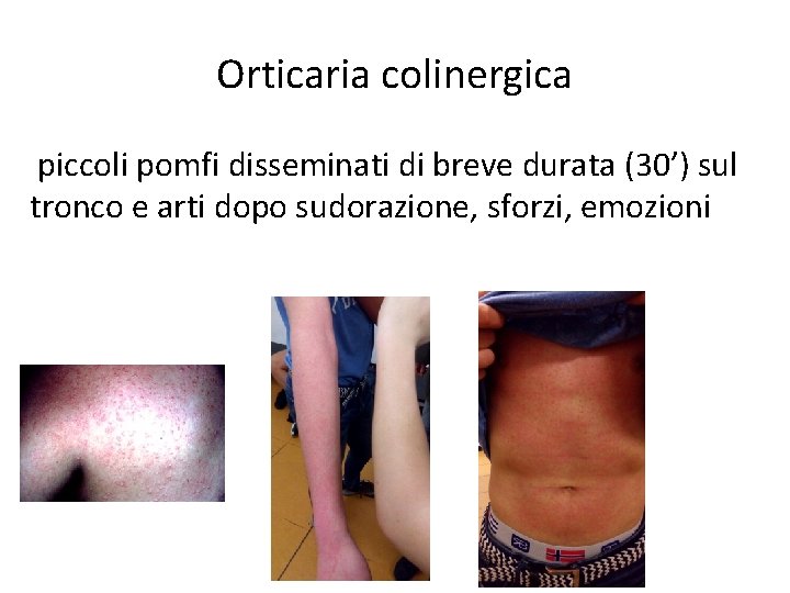Orticaria colinergica piccoli pomfi disseminati di breve durata (30’) sul tronco e arti dopo