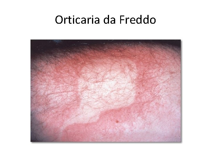 Orticaria da Freddo 