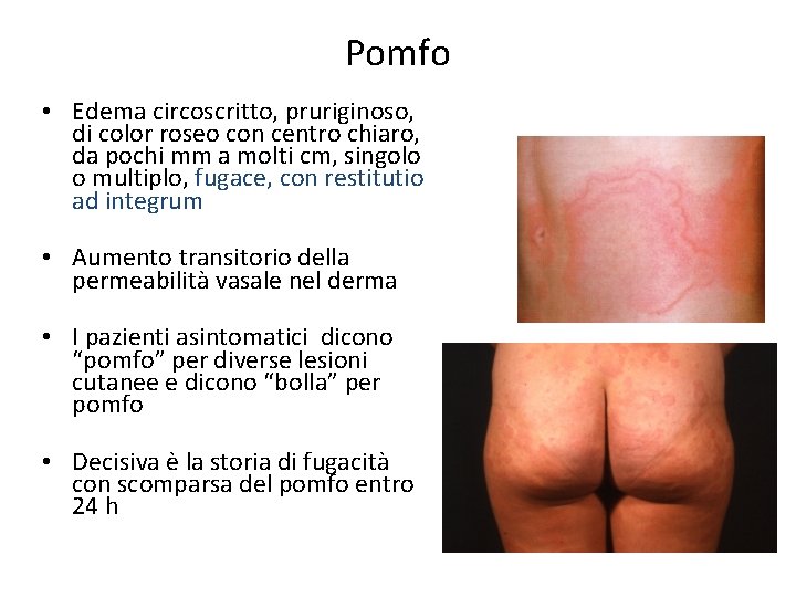 Pomfo • Edema circoscritto, pruriginoso, di color roseo con centro chiaro, da pochi mm
