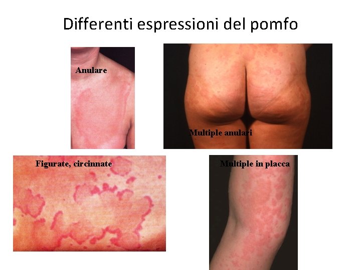 Differenti espressioni del pomfo Anulare Multiple anulari Figurate, circinnate Multiple in placca 