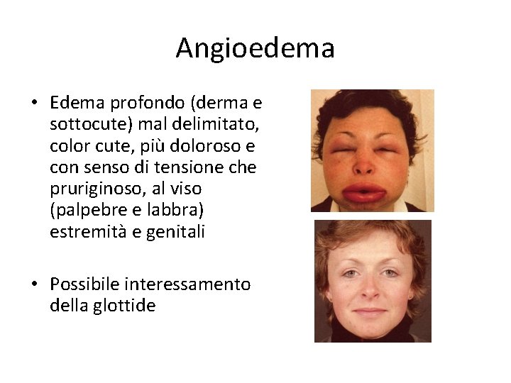 Angioedema • Edema profondo (derma e sottocute) mal delimitato, color cute, più doloroso e
