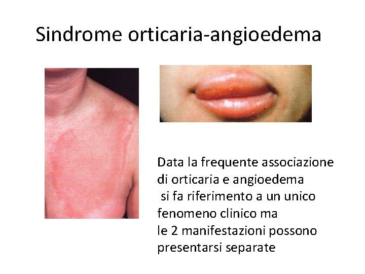 Sindrome orticaria-angioedema Data la frequente associazione di orticaria e angioedema si fa riferimento a
