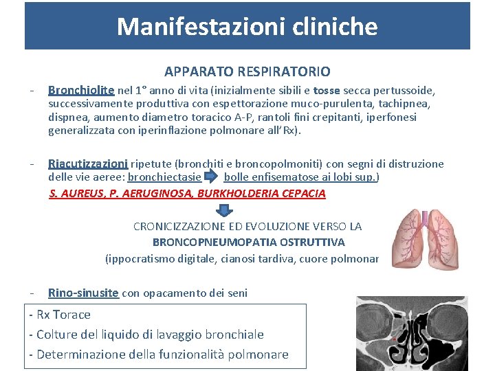 Manifestazioni cliniche APPARATO RESPIRATORIO - Bronchiolite nel 1° anno di vita (inizialmente sibili e