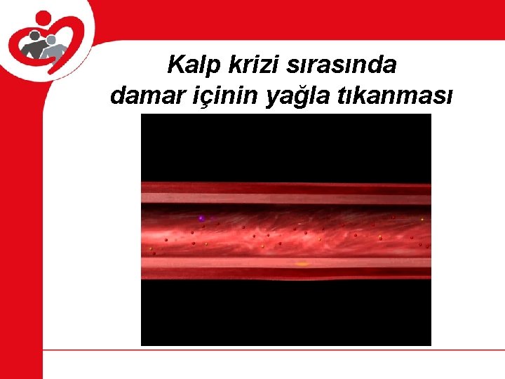 Kalp krizi sırasında damar içinin yağla tıkanması FİLMMMM 