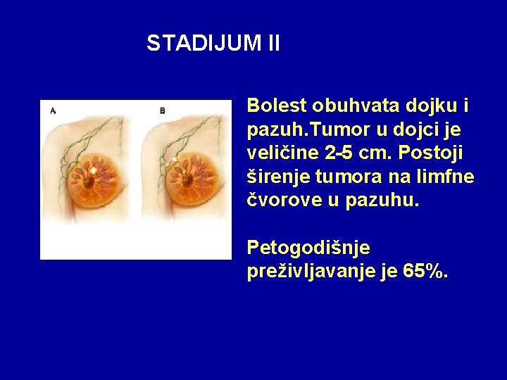 STADIJUM II Bolest obuhvata dojku i pazuh. Tumor u dojci je veličine 2 -5