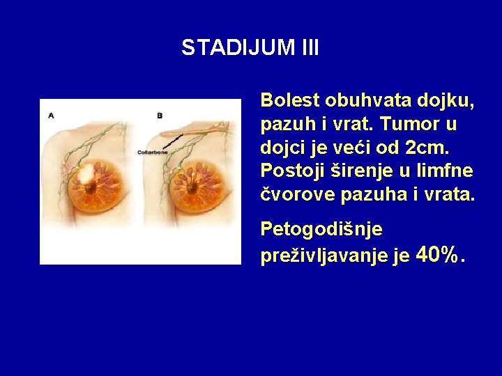 STADIJUM III Bolest obuhvata dojku, pazuh i vrat. Tumor u dojci je veći od