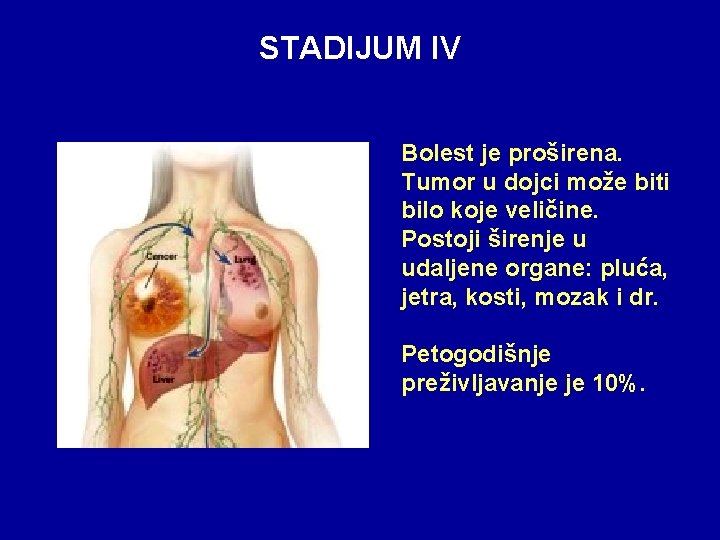 STADIJUM IV Bolest je proširena. Tumor u dojci može biti bilo koje veličine. Postoji