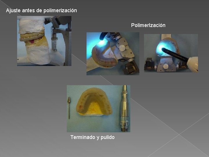 Ajuste antes de polimerización Polimer. Ización Terminado y pulido 