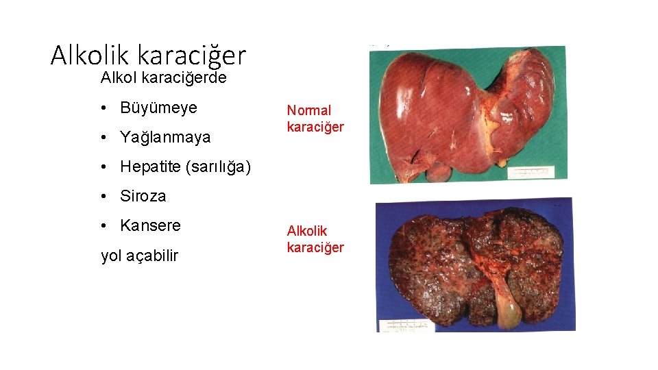 Alkolik karaciğer Alkol karaciğerde • Büyümeye • Yağlanmaya Normal karaciğer • Hepatite (sarılığa) •