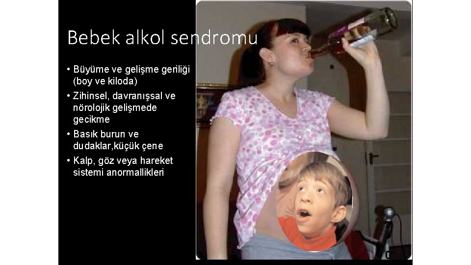 Bebek alkol sendromu • Büyüme ve gelişme geriliği (boy ve kiloda) • Zihinsel, davranışsal