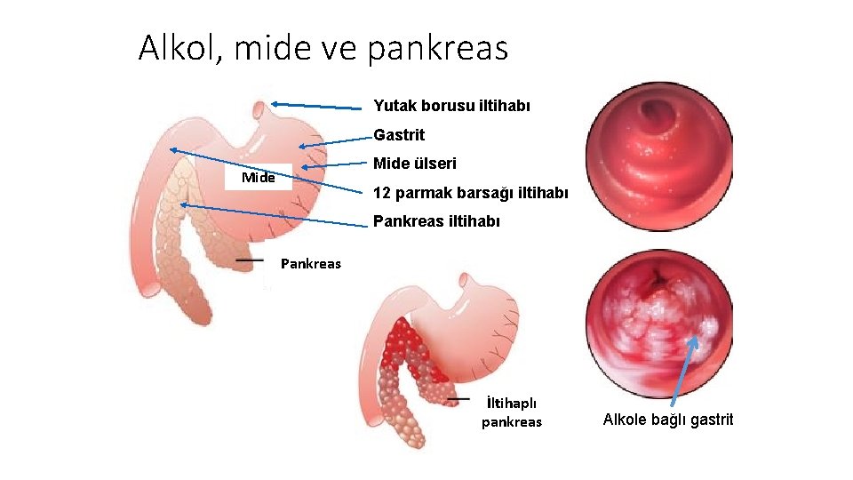 Alkol, mide ve pankreas Yutak borusu iltihabı Gastrit Mide ülseri Mide 12 parmak barsağı