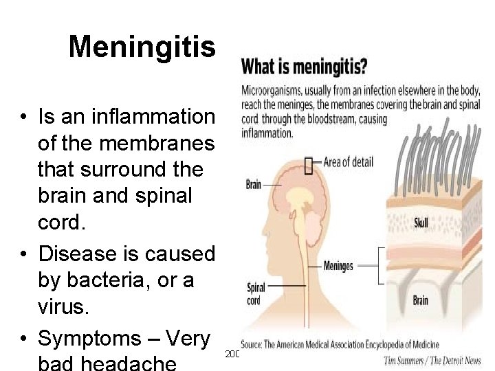 Meningitis • Is an inflammation of the membranes that surround the brain and spinal