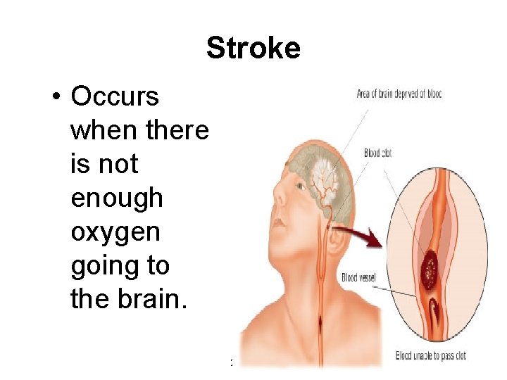 Stroke • Occurs when there is not enough oxygen going to the brain. 2003