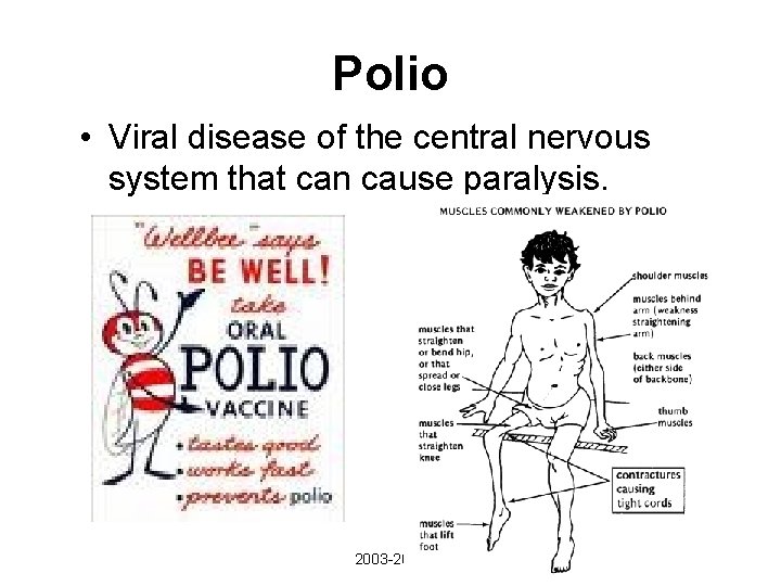 Polio • Viral disease of the central nervous system that can cause paralysis. 2003