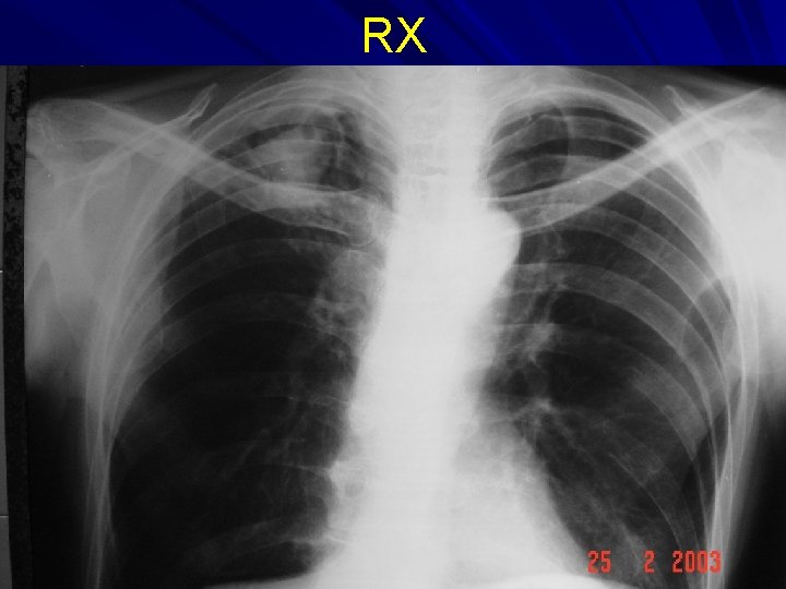 RX 