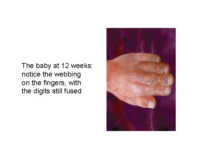 The baby at 12 weeks: notice the webbing on the fingers, with the digits The baby at 12 weeks: notice the webbing on the fingers, with the digits