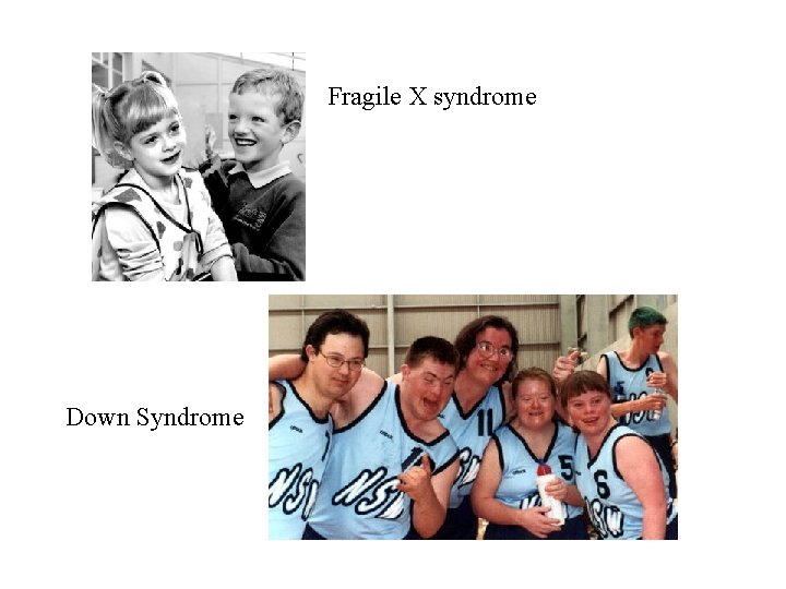 Fragile X syndrome Down Syndrome 