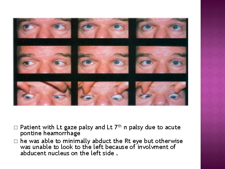 � � Patient with Lt gaze palsy and Lt 7 th n palsy due � � Patient with Lt gaze palsy and Lt 7 th n palsy due