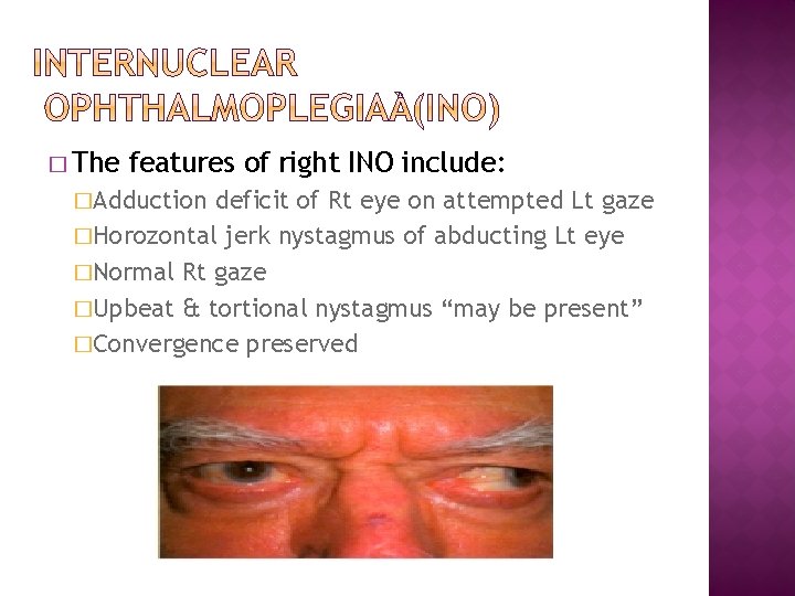 � The features of right INO include: �Adduction deficit of Rt eye on attempted � The features of right INO include: �Adduction deficit of Rt eye on attempted