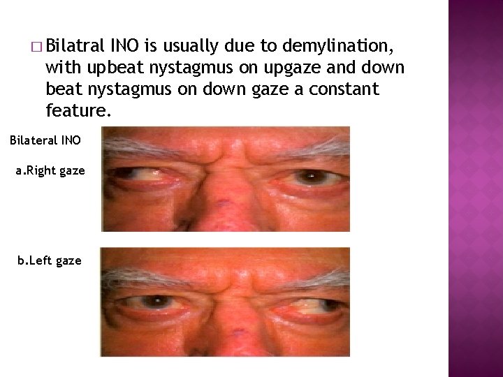 � Bilatral INO is usually due to demylination, with upbeat nystagmus on upgaze and � Bilatral INO is usually due to demylination, with upbeat nystagmus on upgaze and