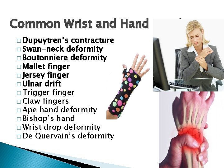 Common Wrist and Hand Conditions � Dupuytren’s contracture � Swan-neck deformity � Boutonniere deformity