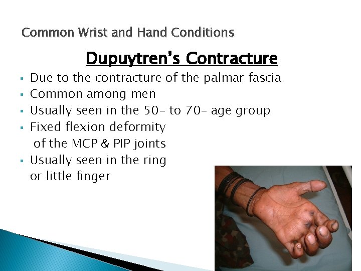 Common Wrist and Hand Conditions Dupuytren’s Contracture § § § Due to the contracture