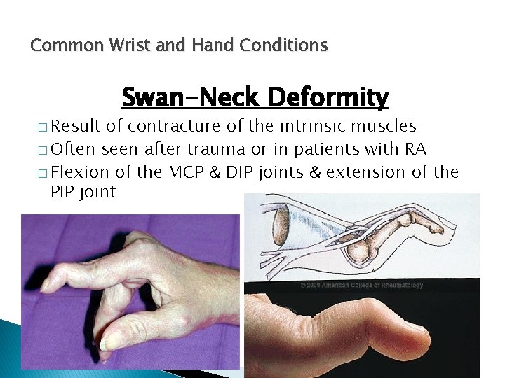 Common Wrist and Hand Conditions � Result Swan-Neck Deformity of contracture of the intrinsic