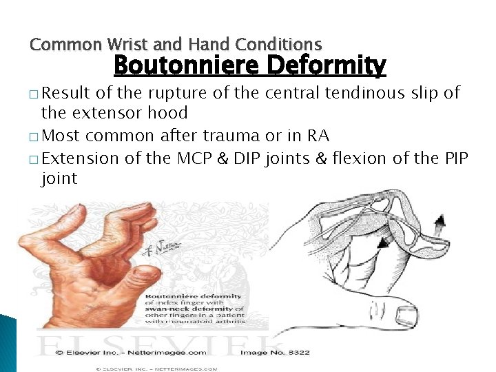 Common Wrist and Hand Conditions � Result Boutonniere Deformity of the rupture of the