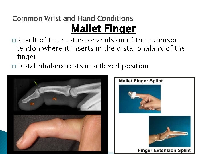 Common Wrist and Hand Conditions � Result Mallet Finger of the rupture or avulsion