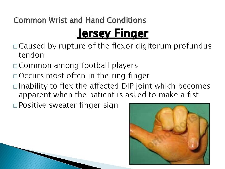 Common Wrist and Hand Conditions � Caused Jersey Finger by rupture of the flexor