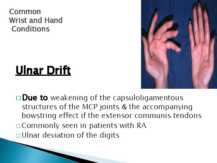 Common Wrist and Hand Conditions Ulnar Drift � Due to weakening of the capsuloligamentous