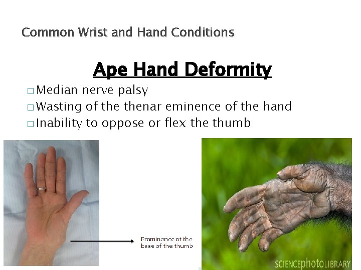 Common Wrist and Hand Conditions � Median Ape Hand Deformity nerve palsy � Wasting