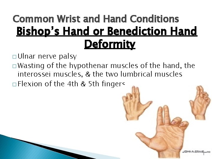 Common Wrist and Hand Conditions Bishop’s Hand or Benediction Hand Deformity � Ulnar nerve