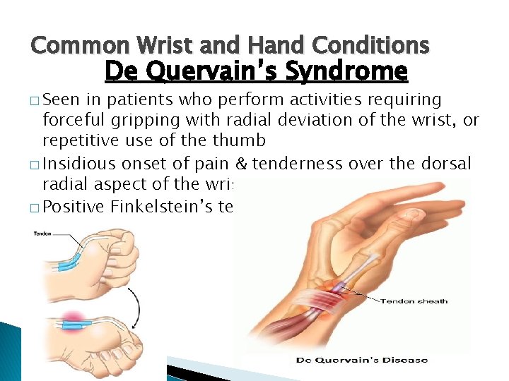 Common Wrist and Hand Conditions � Seen De Quervain’s Syndrome in patients who perform