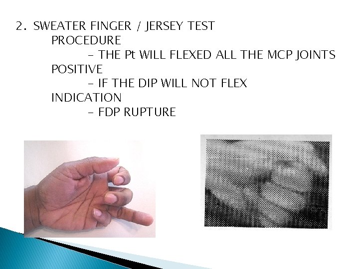 2. SWEATER FINGER / JERSEY TEST PROCEDURE - THE Pt WILL FLEXED ALL THE